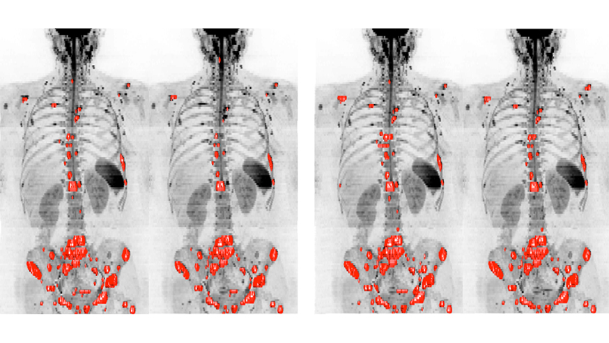 Whole body MRI scans of a breast cancer patient, assessed by two observers, to measure tumours in the patient's bones.  The software could help clinicians reliably assess how bone disease changes over time (image: Blackledge et al 2016)