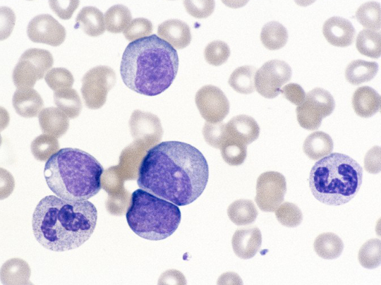 Chronic myeloid leukaemia cells, image used form Wellcome Image Library