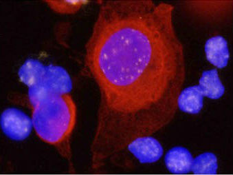 Prostate cancer circulating tumour cells