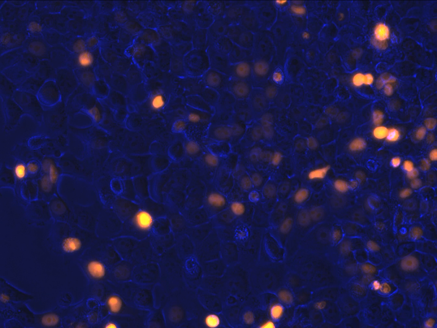 Blue E-cadherin defective cells under the microscope with yellow hotspots