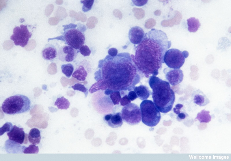 Hodgkin Lymphoma. Wellcome Images / Creative Commons by-nc-nd 4.0