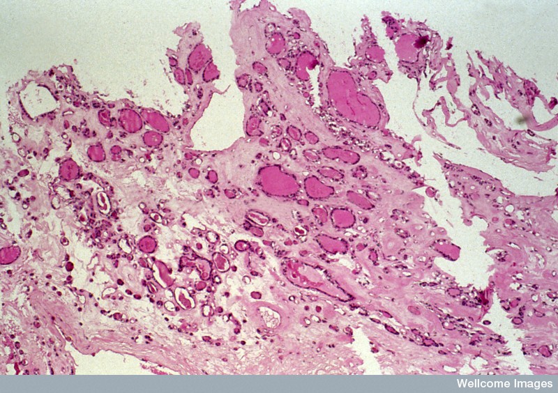 Metastatic carcinoma from thyroid x 100 (c) Wellcome Photo Library / Creative Commons by-nc-nd 2.0 UK