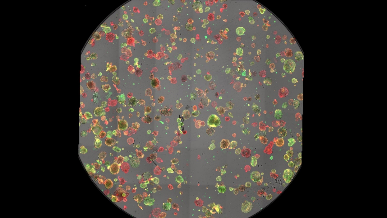 High-Grade Serous Ovarian Carcinoma (HGSOC) organoids