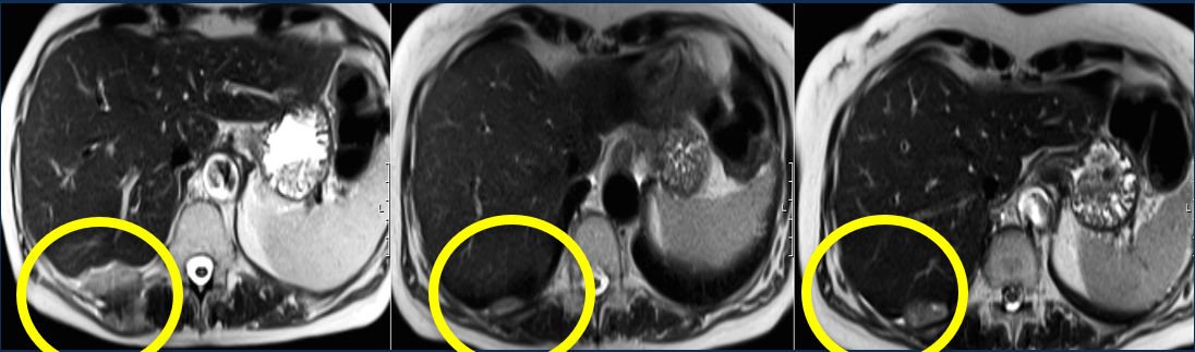 MRI of tumour reducing in size over time after given idetrexed