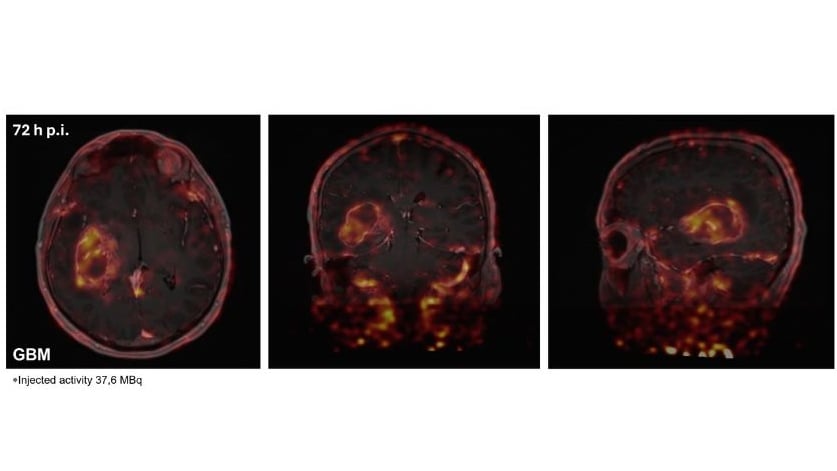 PET scans of a glioblastoma patient's brain, 72 hours after injection with the radiotracer.