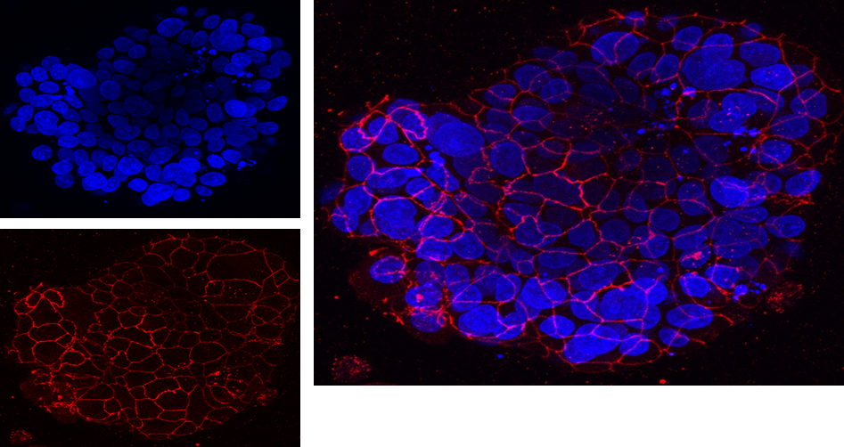 Organoid or ‘live mini tumours’ of high grade serous ovarian cancer